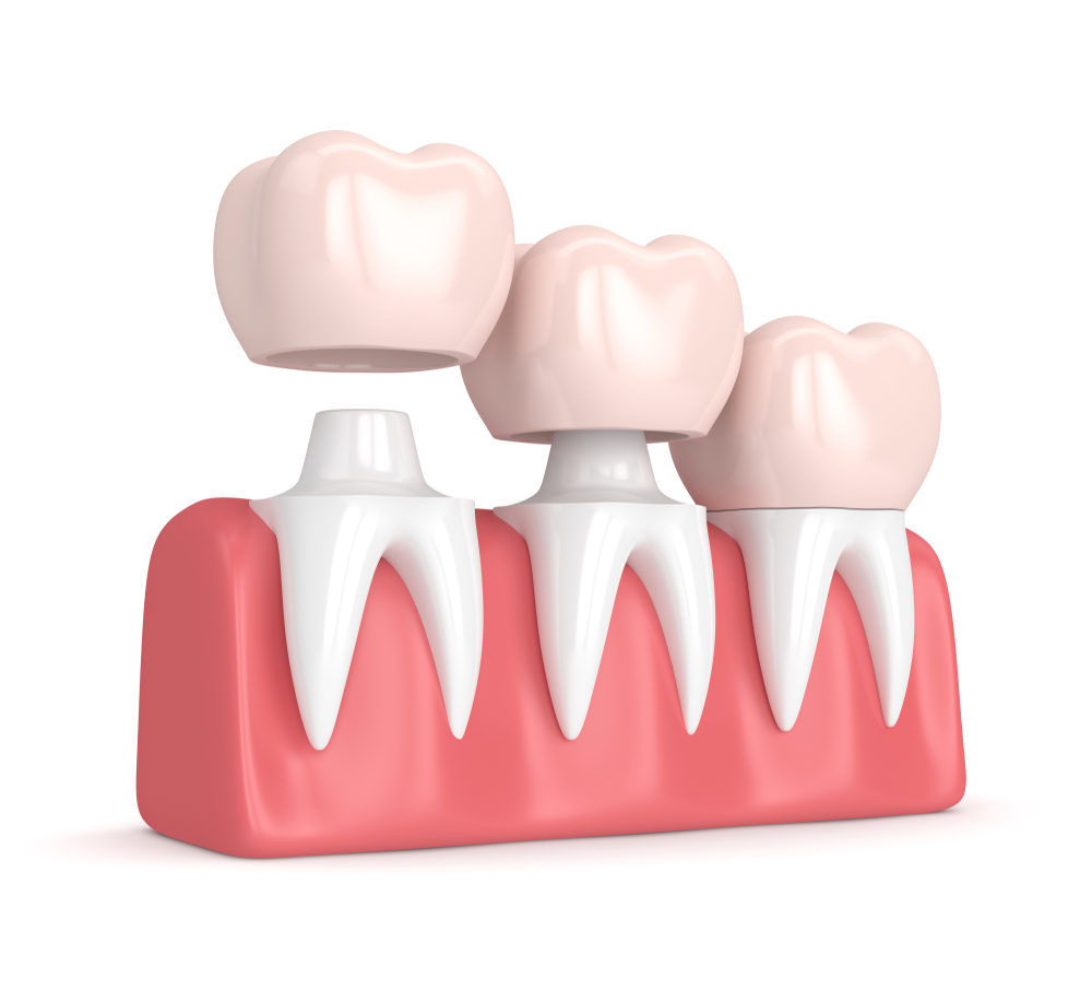 dental crowns midland mi boss and rorvik dentistry